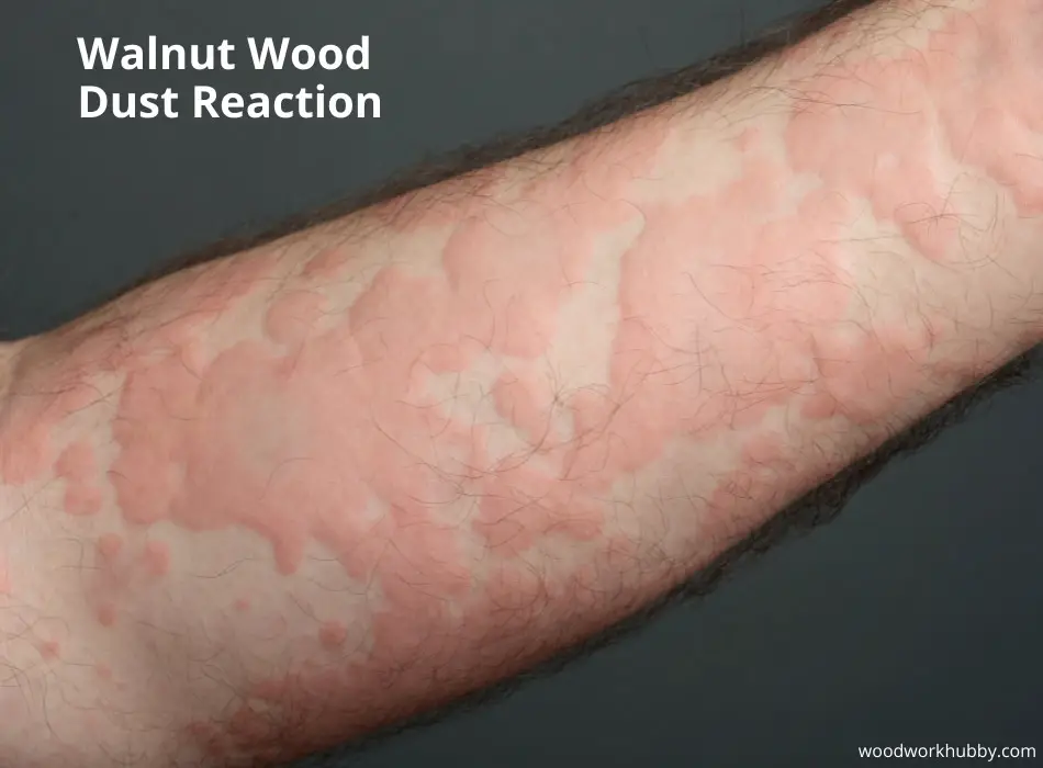 rash on forearm from walnut wood dust