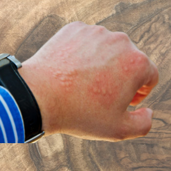 Can Walnut Wood Cause Allergies? Nut Allergy Truth 2 rash on back of hand from wood dust