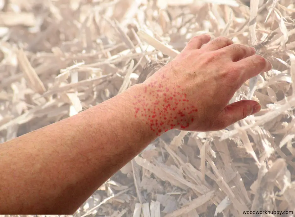 Can Walnut Wood Cause Allergies? Nut Allergy Truth 9 Hives on hand from allergic reaction
